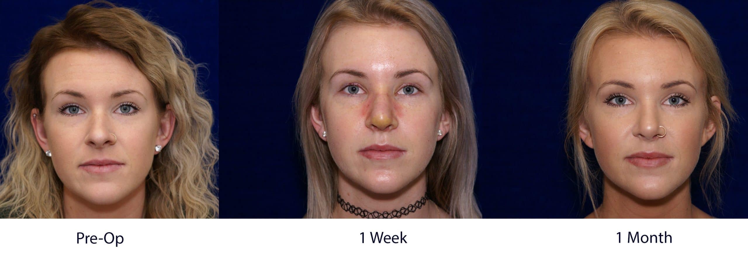 Is Rhinoplasty painful?