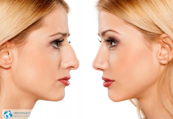 Does rhinoplasty fix a deviated septum?