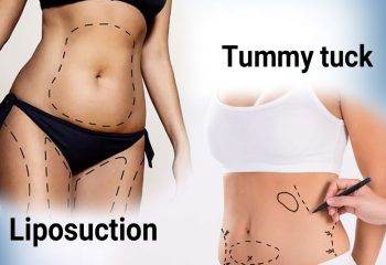 liposuction vs tummy tuck : which is better?