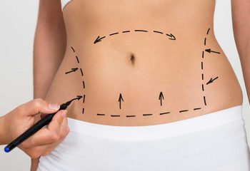 Are tummy tuck results permanent?