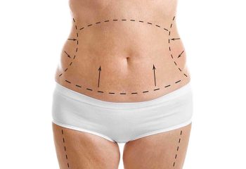 How to improve tummy tuck results?