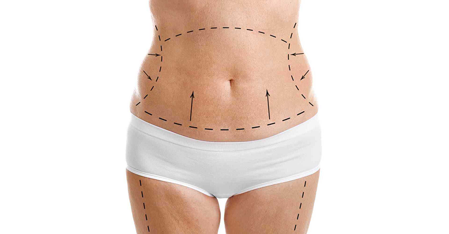 How to improve tummy tuck results?