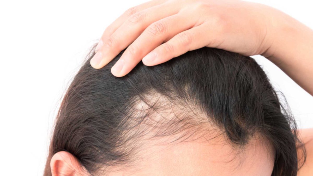 How to stop hair loss after weight loss