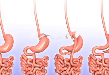 Is gastric sleeve a good idea?