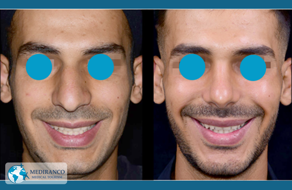 rhinoplasty before and after front view