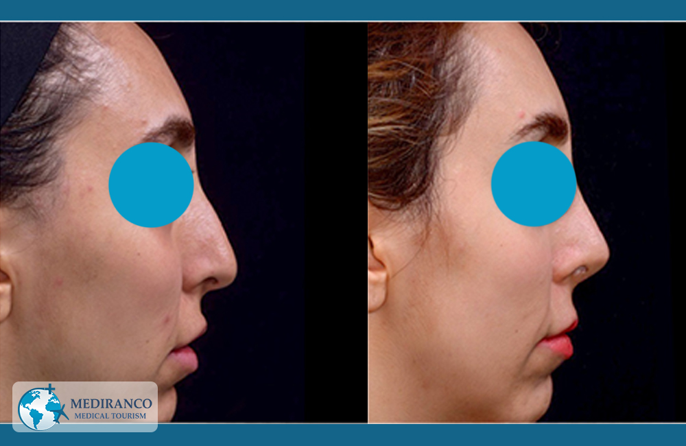 rhinoplasty before and after female