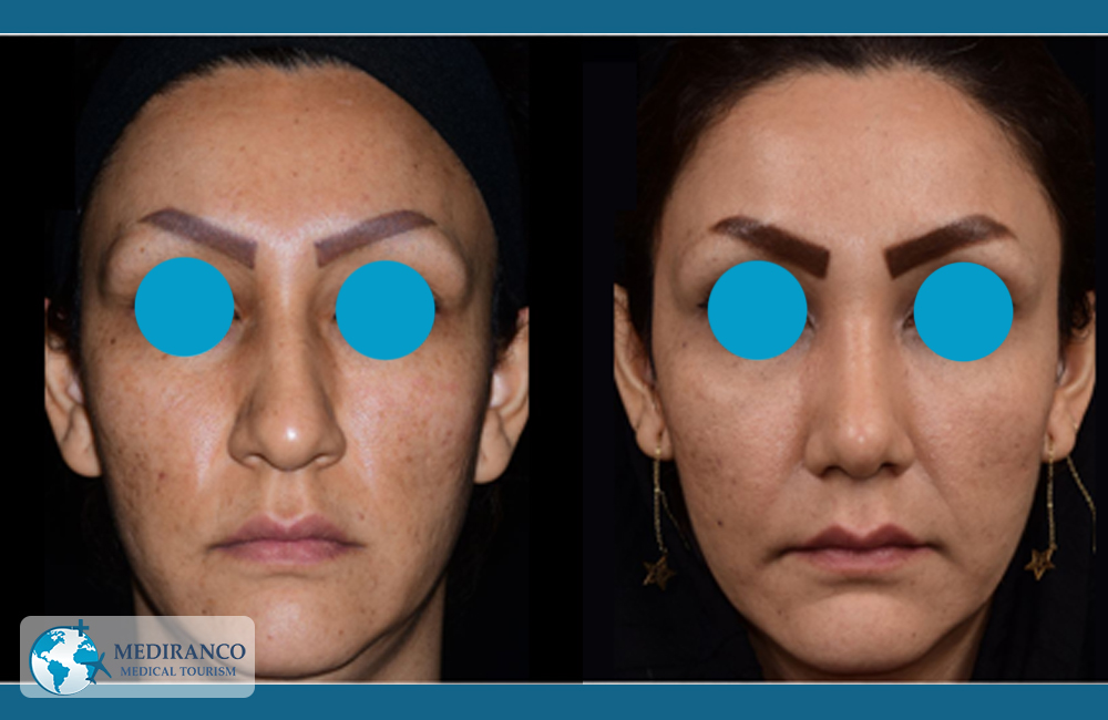rhinoplasty before and after front view