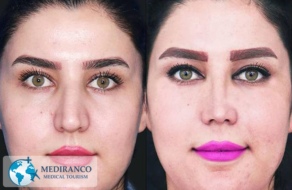 Rhinoplasty in Iran before and after front