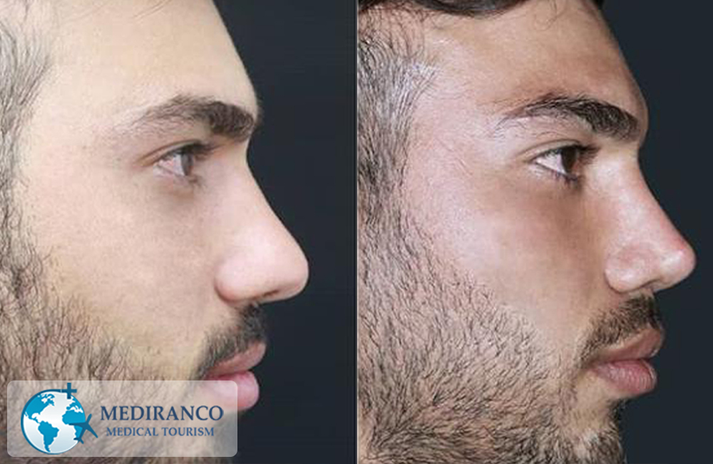 nose job in Iran before and after