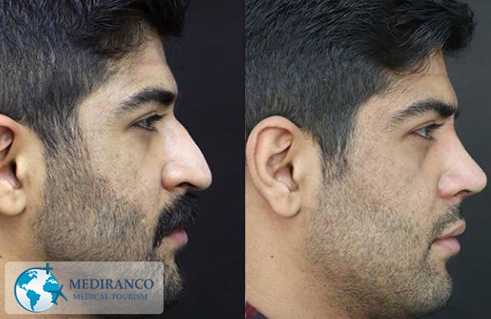 Rhinoplasty in Iran before and after male