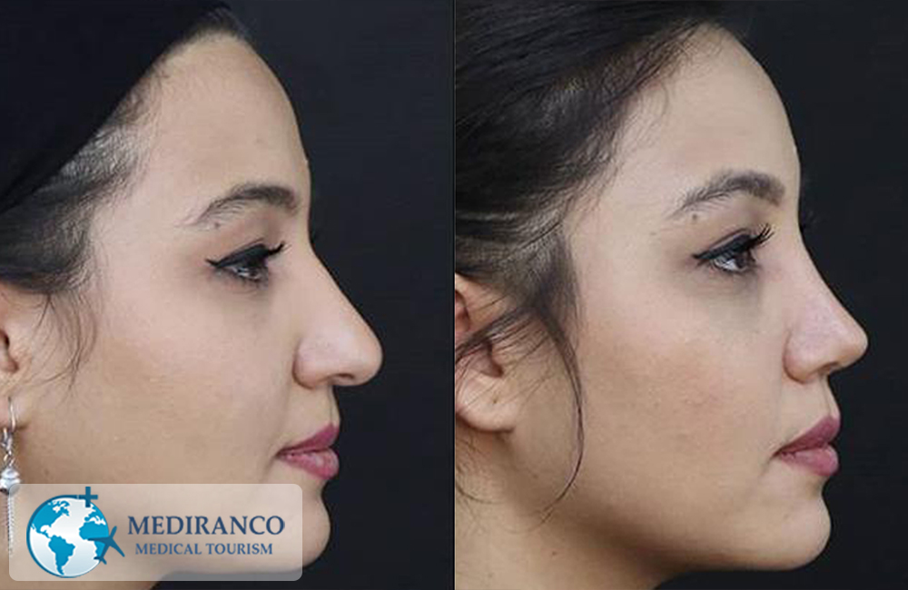 Nose job before and after