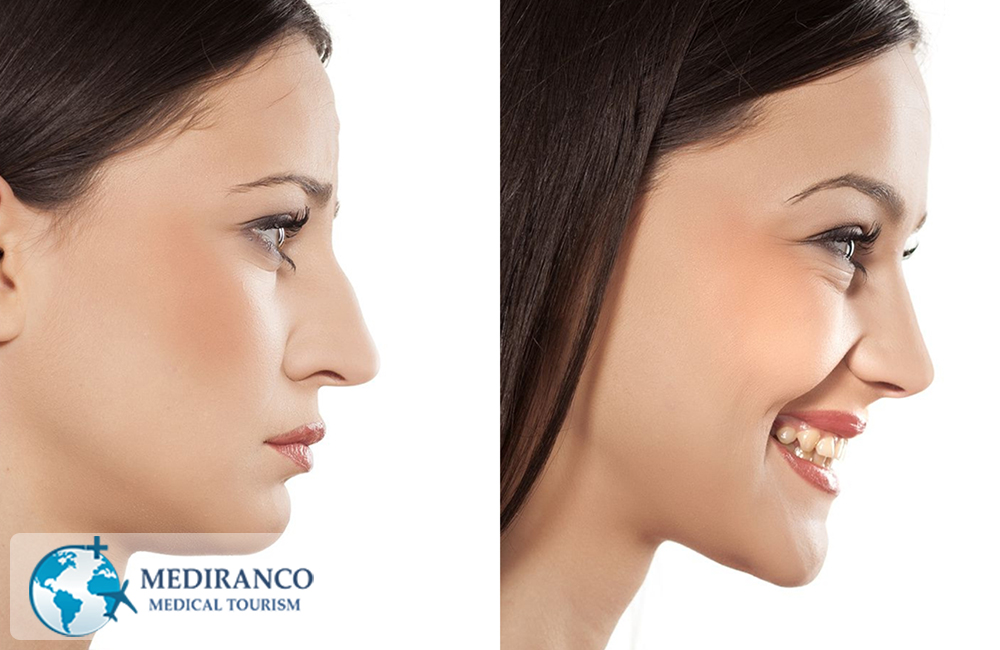 nose job in Iran before and after