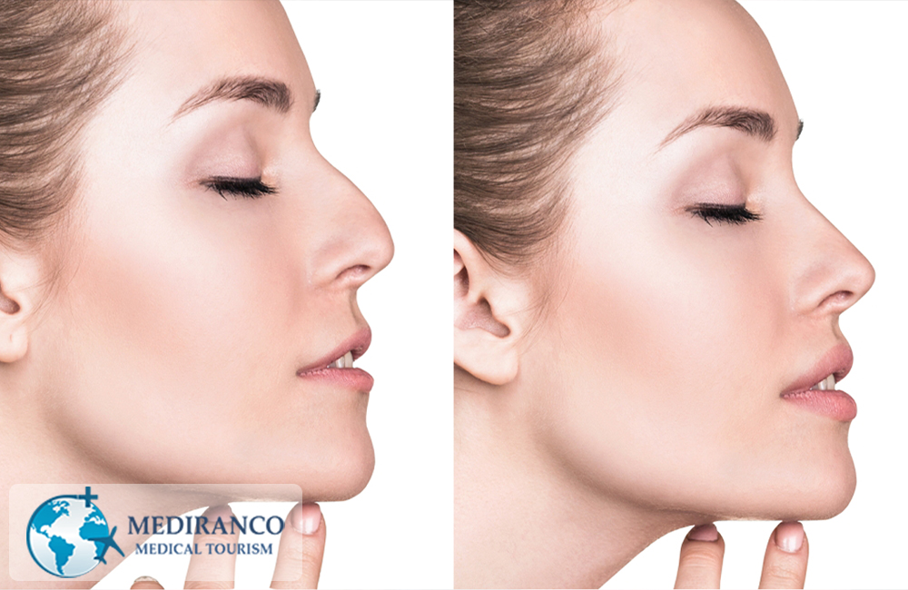 Rhinoplasty in Iran before and after