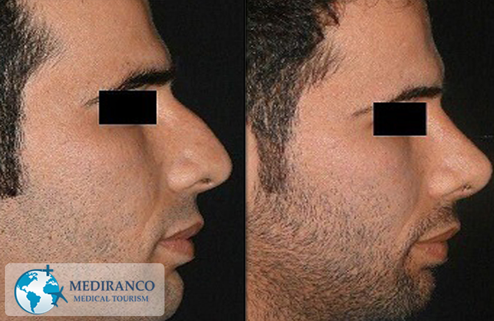 nose job in Iran before and after