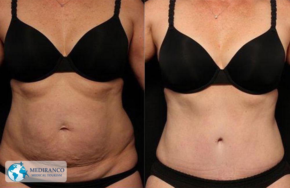 Liposuction surgery Before And After