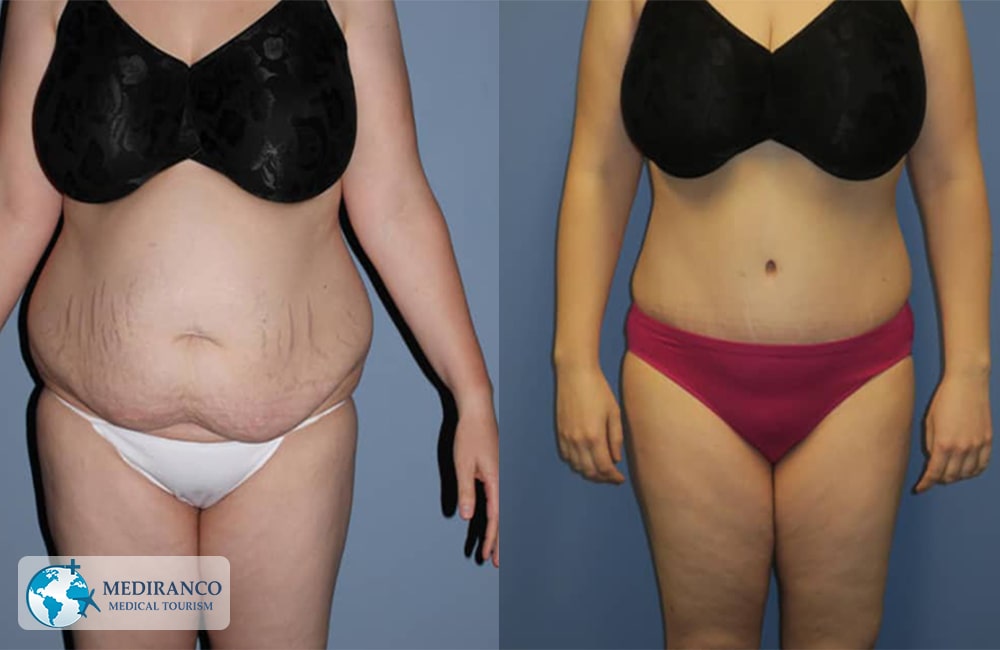 Liposuction in Iran Before And After
