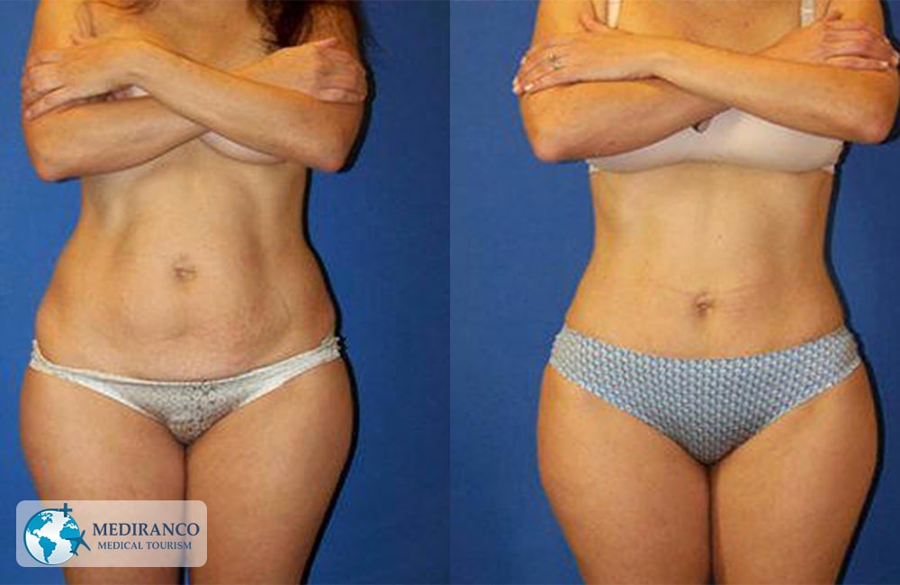 Liposuction in Iran Before And After