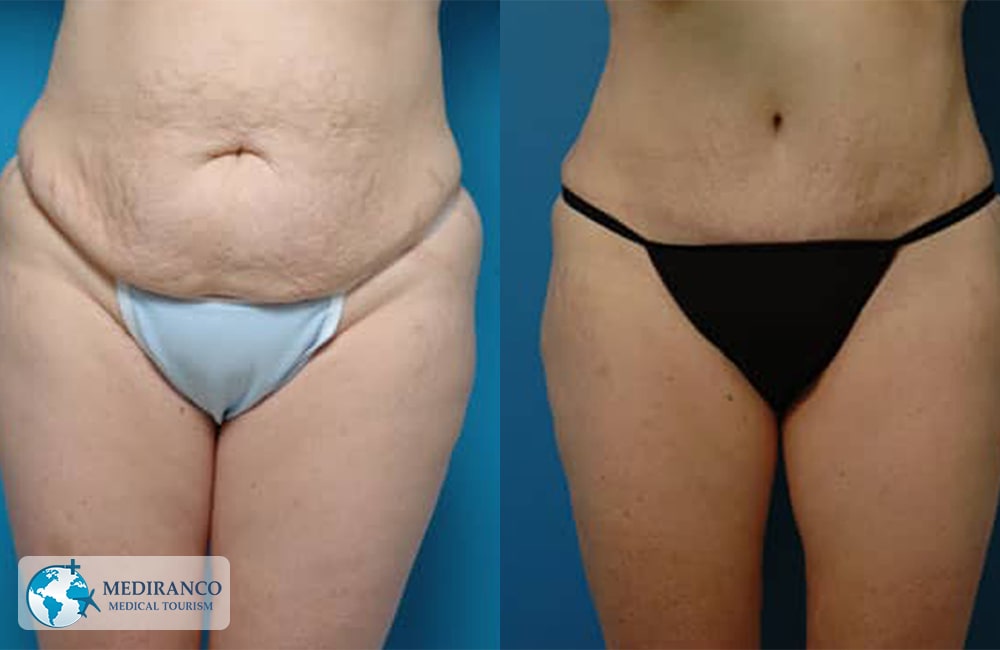 Liposuction Before And After