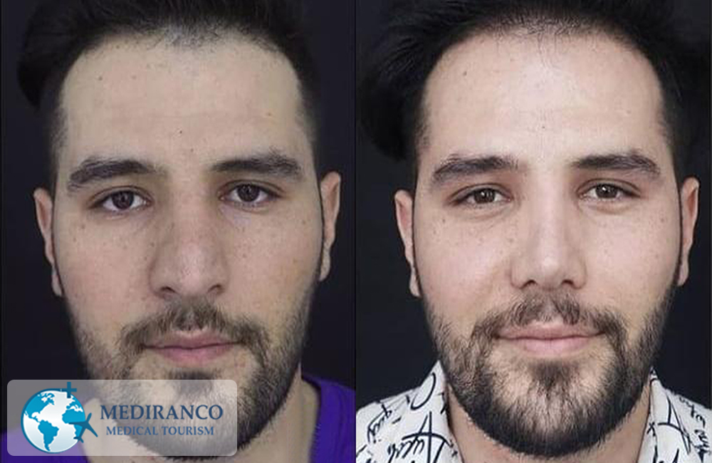 Rhinoplasty in Iran before and after front