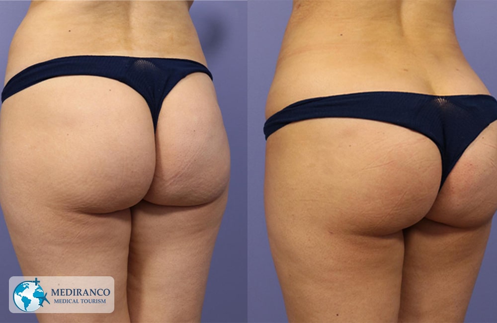 Brazilian Butt Lift in Iran before and after