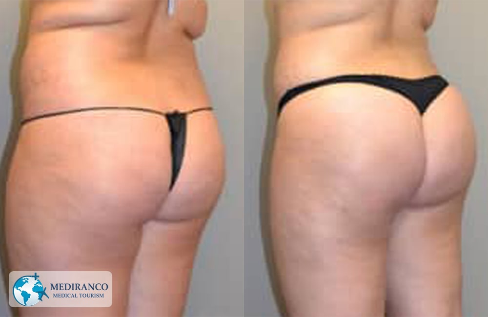 Brazilian Butt Lift in Iran before after photos