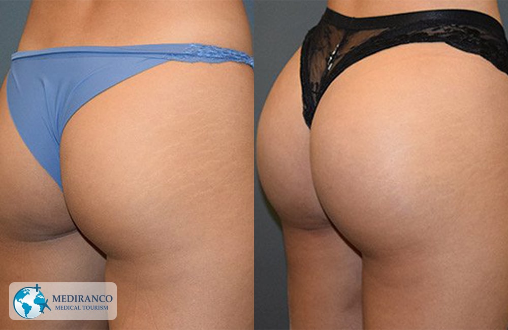 Brazilian Butt Lift in Iran before and after photos