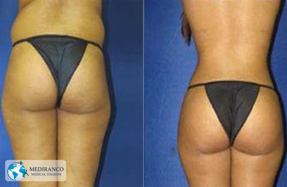 BBL in Iran 2022 - Brazilian Butt lift - After care - irantreatments -  Plastic Surgery in Iran