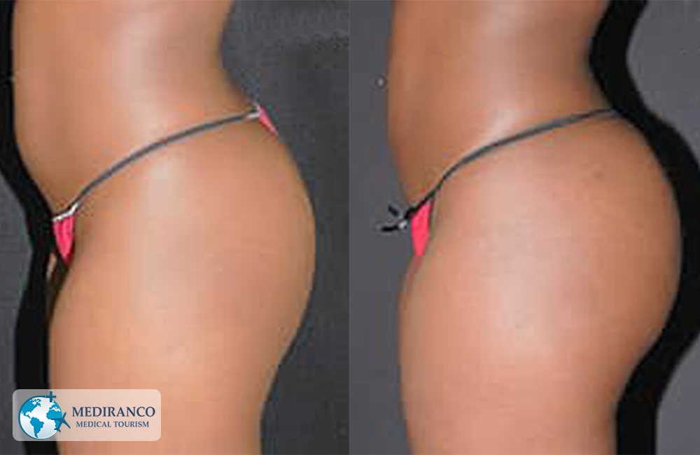 Brazilian Butt Lift in Iran before and after