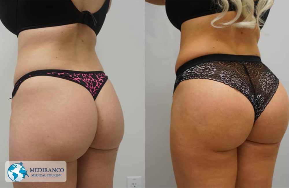 Brazilian Butt Lift in Iran before and after photos