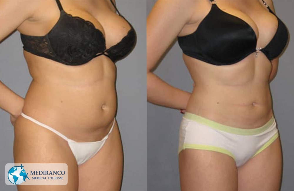 gastric sleeve surgery before and after picture