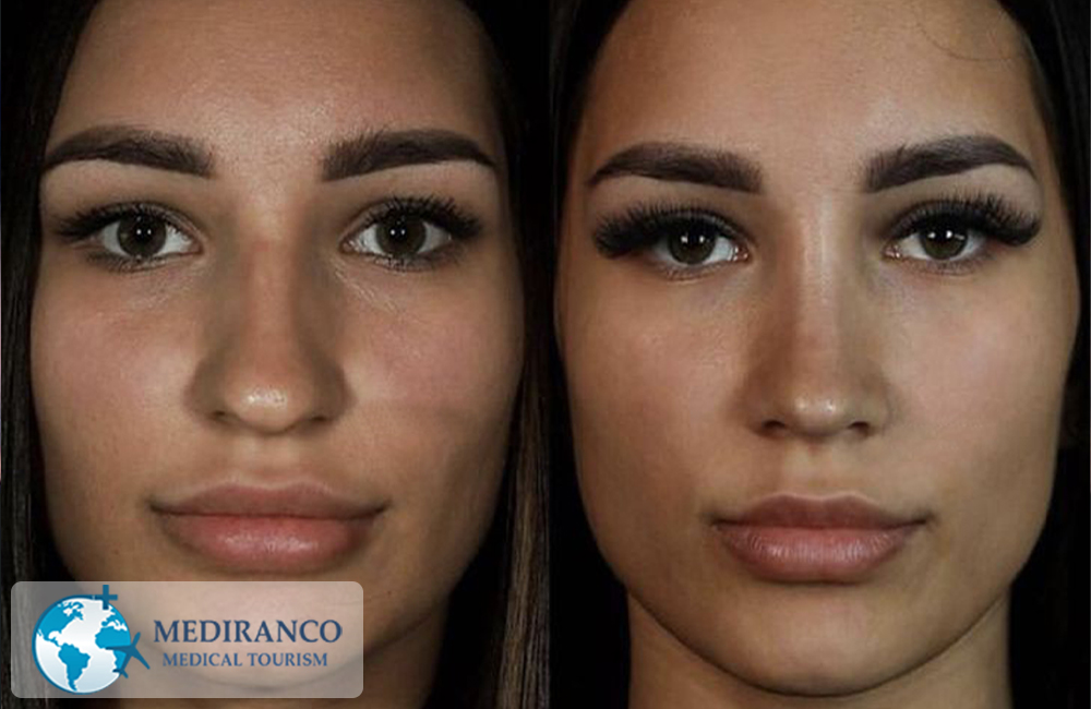 Rhinoplasty in Iran before and after front