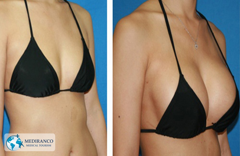 Breast implant in Iran Before and After