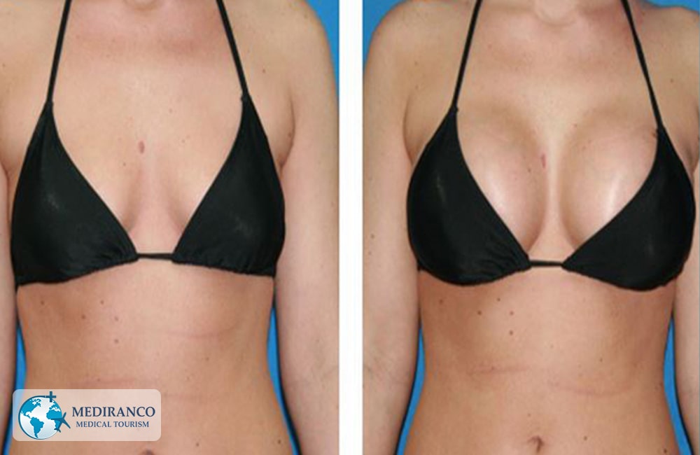 Breast Augmentation in Iran Before and After