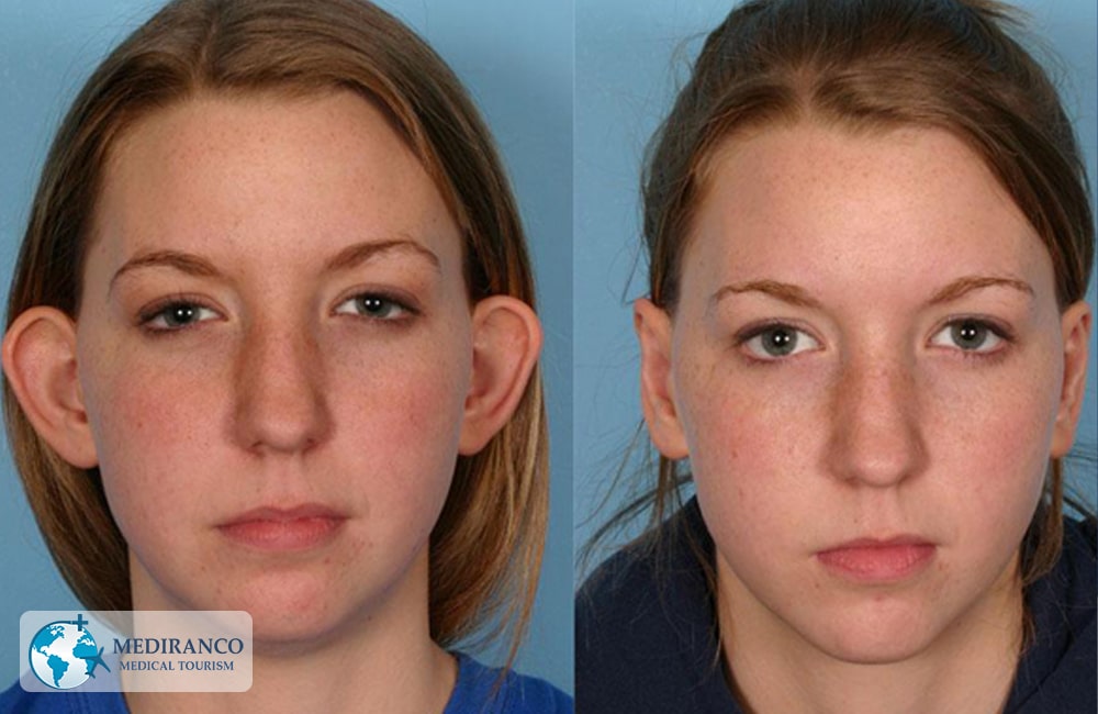 otoplasty before and after