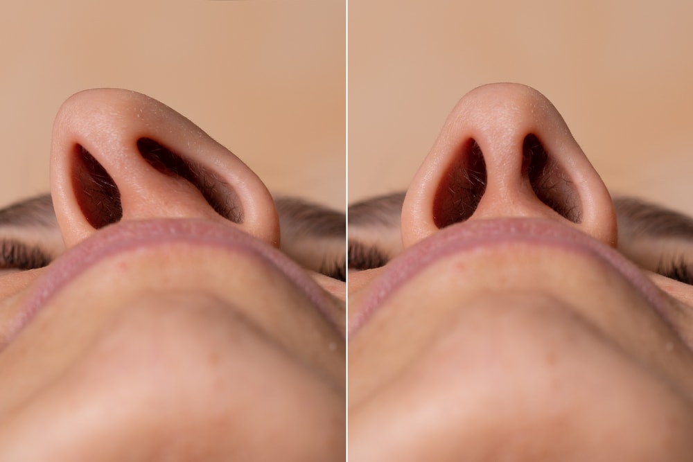 nose job before and after