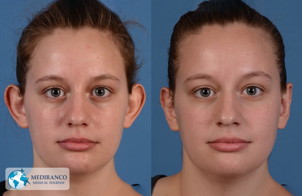 otoplasty before and after photos