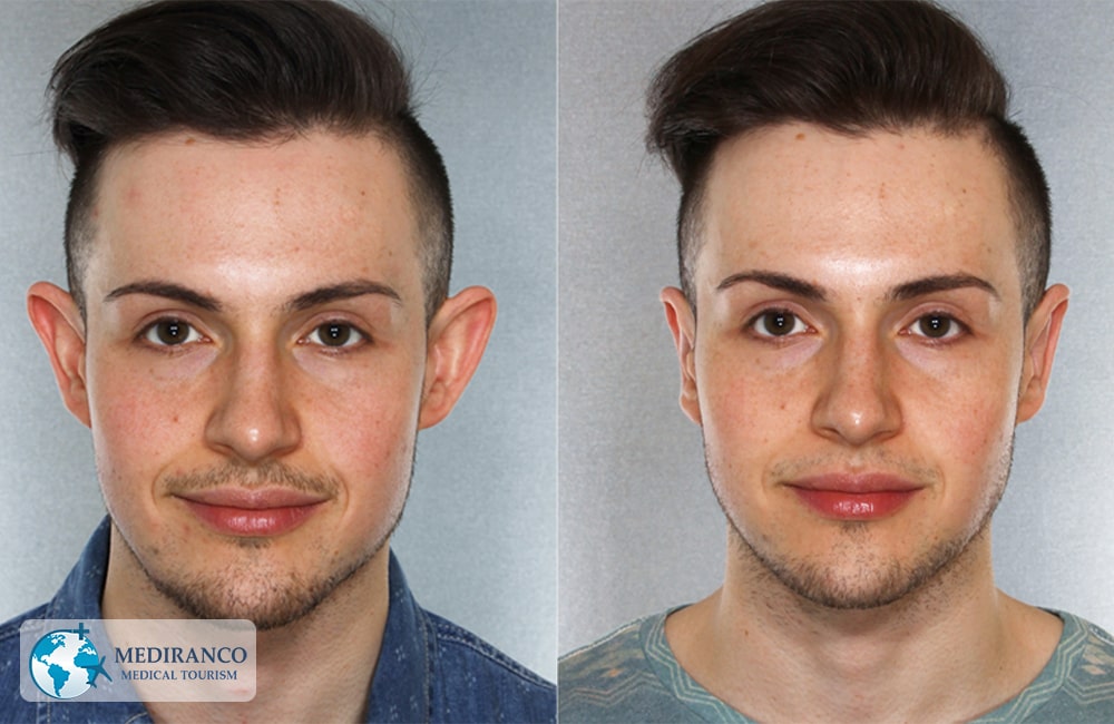 Otoplasty in Iran before and after