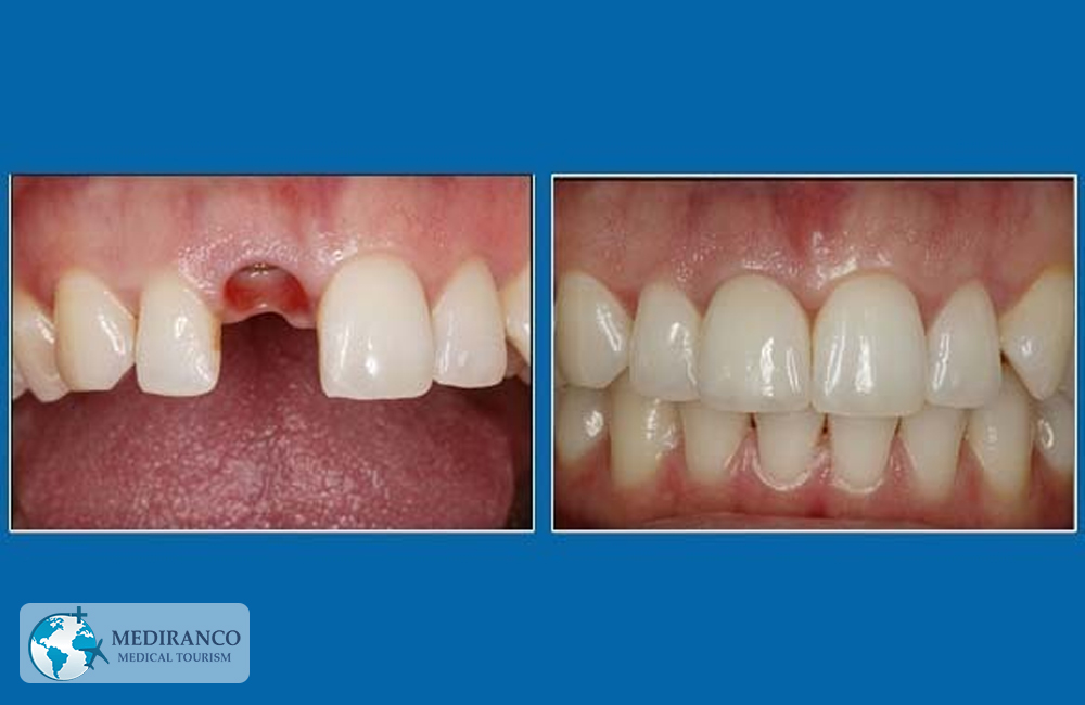 before and after Dental Implant in Iran