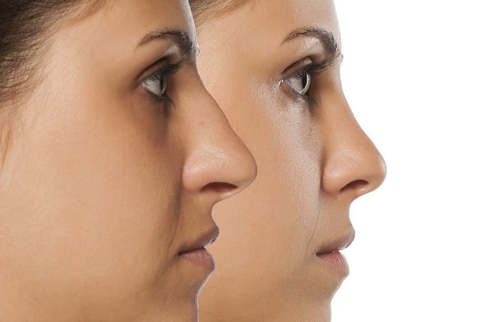 nose job before and after