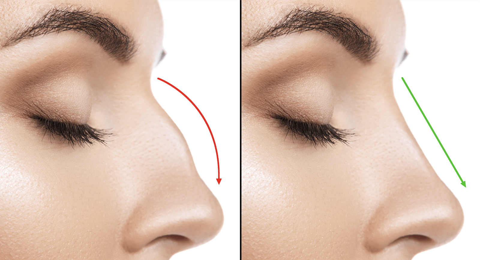 Nasal hump before and after