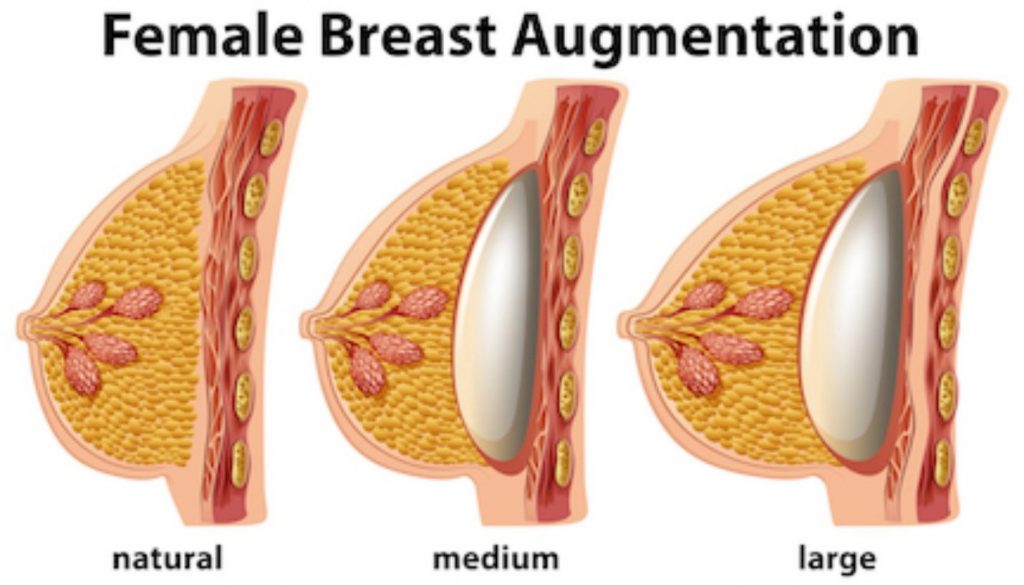 What is Gummy bear breast implants?