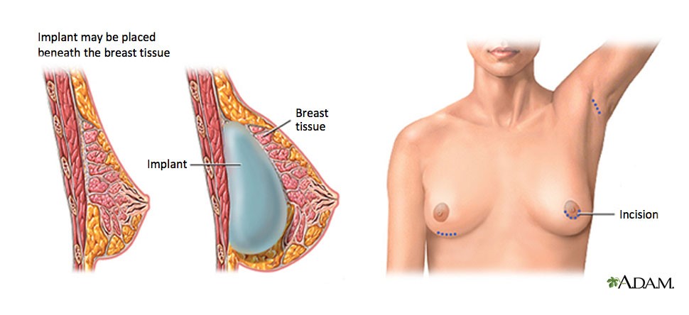 All you need to know about breast enhancement or boob job