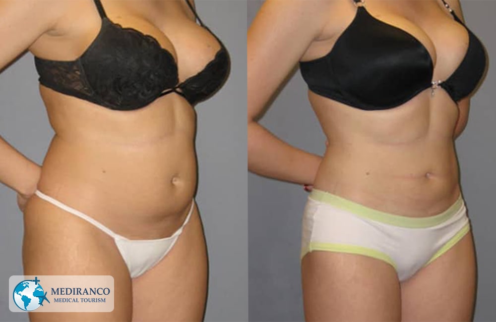 Abdominoplasty