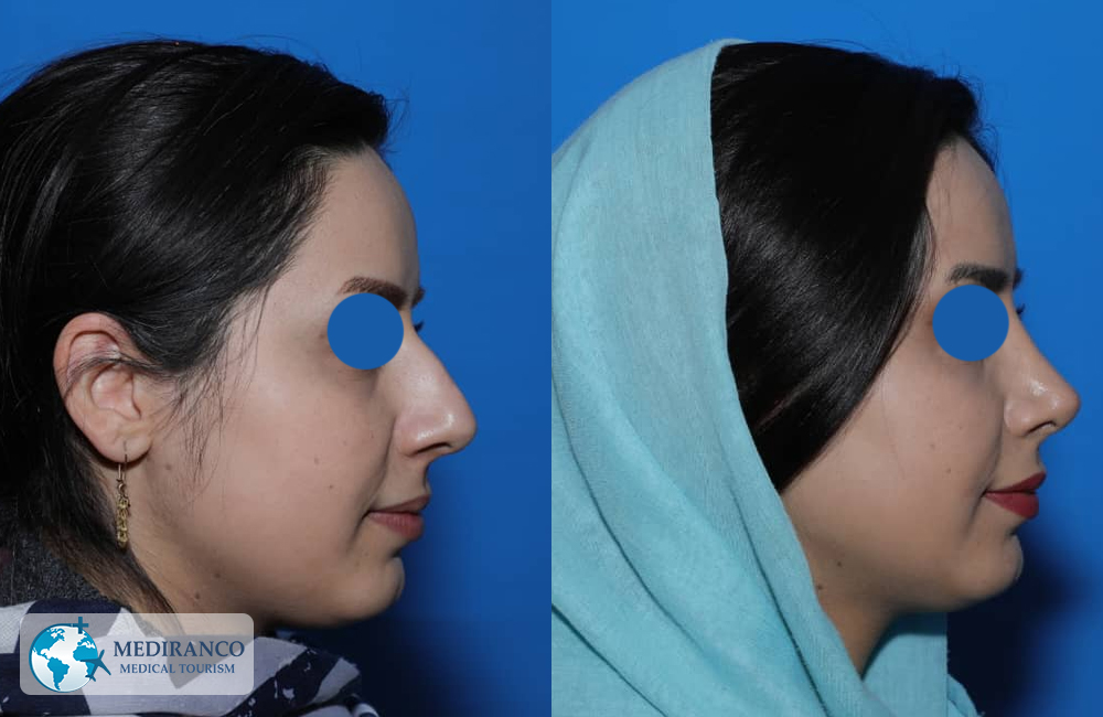 nose job before and after female