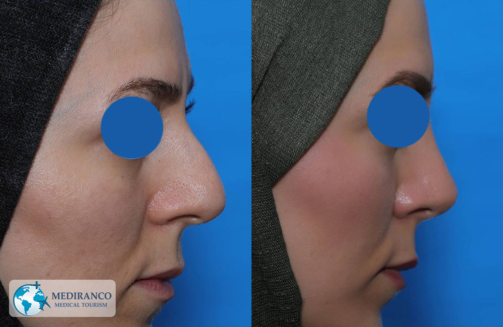 Rhinoplasty in Iran before and female