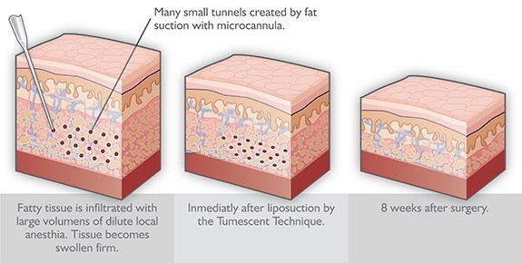 types of liposuction