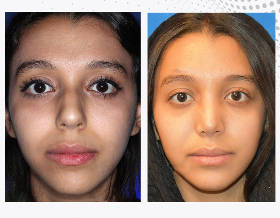 Before & After Cartilaginous Nose