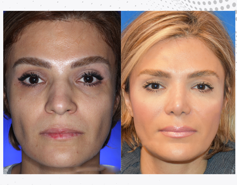 Before & After Rhinoplasty female