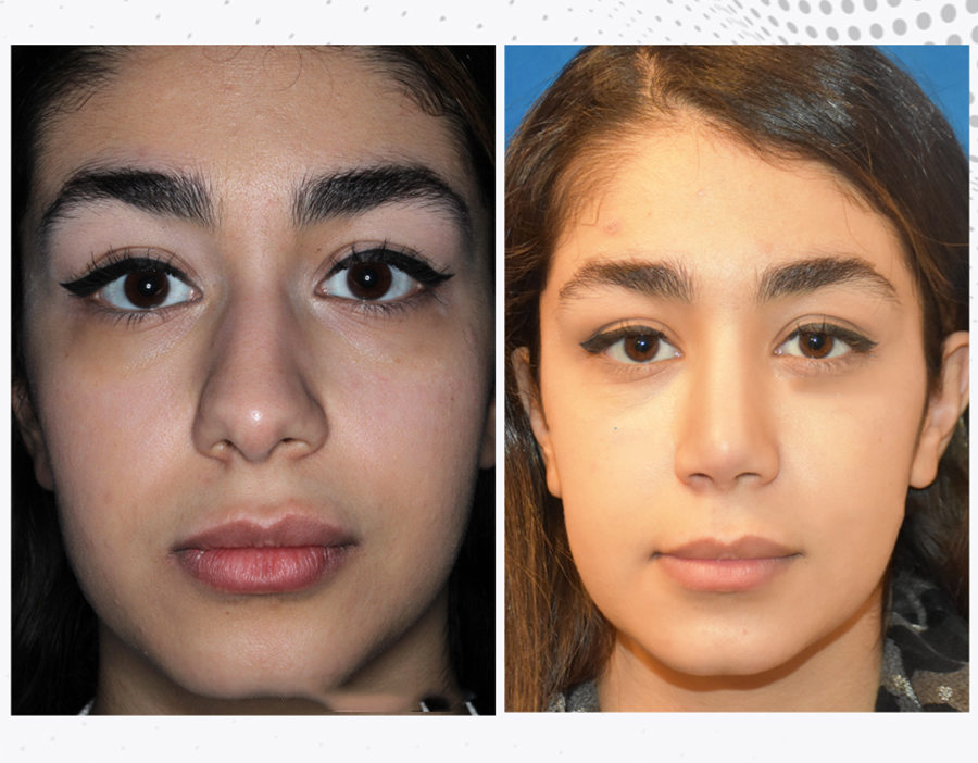 Before & After Rhinoplasty