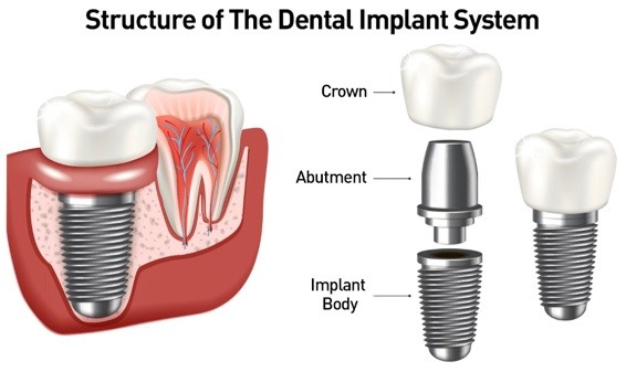 Facts about dental implants